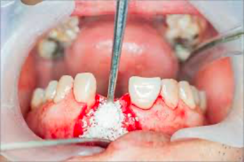 img Implant