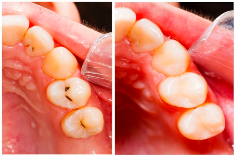 img Implant
