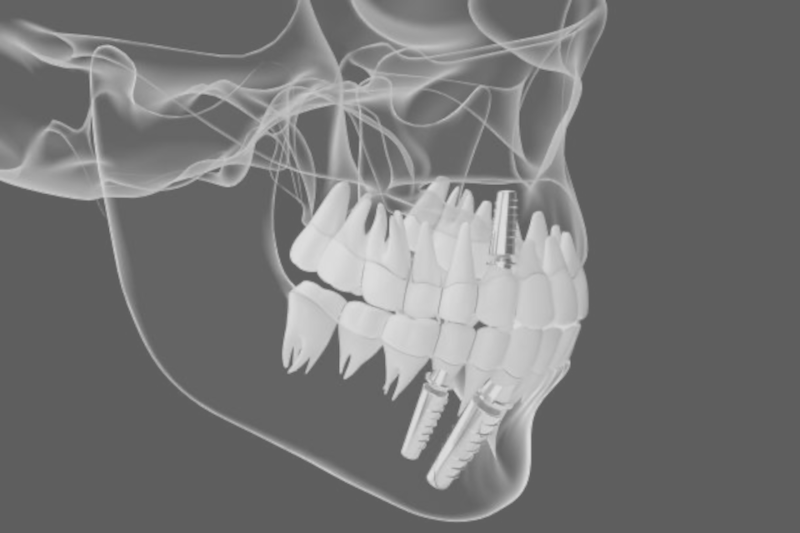 img Implant