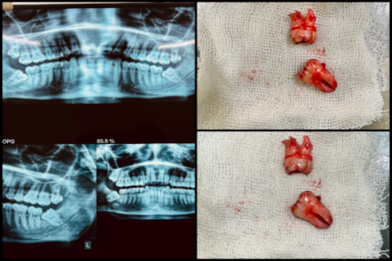 img Implant