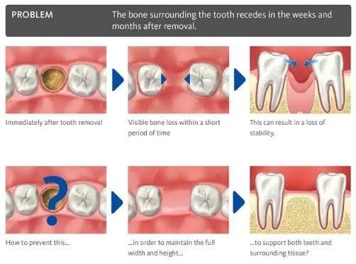 Bone Grafting