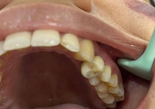 Dentures