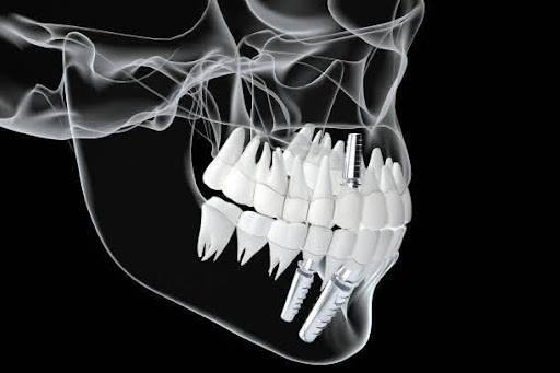 Dentures