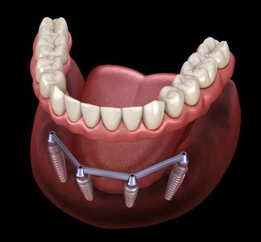 Dental Implants