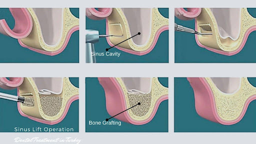 sinus lift