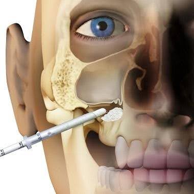 sinus lift