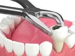 Tooth Extraction 
