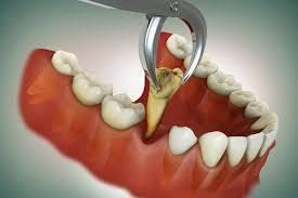 Tooth Extraction 