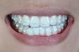 Invisalign Treatment