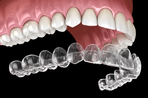 Invisalign Treatment