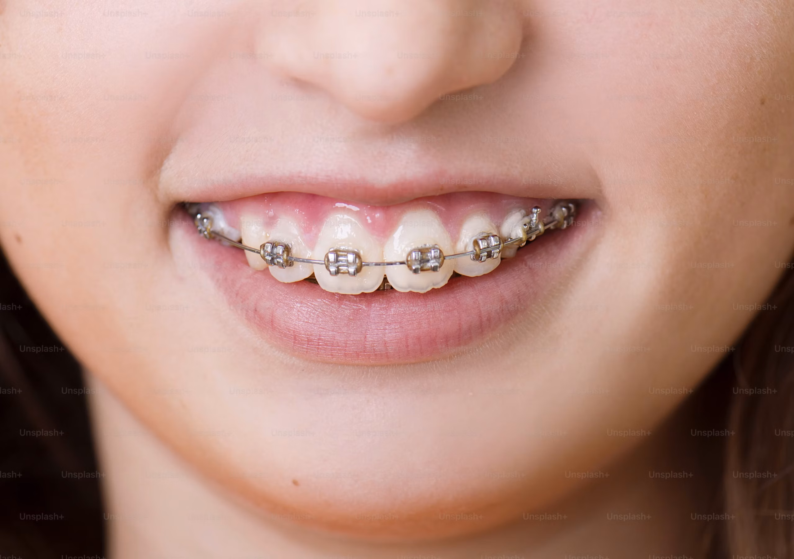 orthodontic treatment